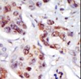 PIP4K2C Antibody - Formalin-fixed and paraffin-embedded human cancer tissue reacted with the primary antibody, which was peroxidase-conjugated to the secondary antibody, followed by AEC staining. This data demonstrates the use of this antibody for immunohistochemistry; clinical relevance has not been evaluated. BC = breast carcinoma; HC = hepatocarcinoma.