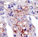 PIP5K1C Antibody - Formalin-fixed and paraffin-embedded human cancer tissue reacted with the primary antibody, which was peroxidase-conjugated to the secondary antibody, followed by AEC staining. This data demonstrates the use of this antibody for immunohistochemistry; clinical relevance has not been evaluated. BC = breast carcinoma; HC = hepatocarcinoma.