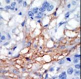 PIP5K1C Antibody - Formalin-fixed and paraffin-embedded human cancer tissue reacted with the primary antibody, which was peroxidase-conjugated to the secondary antibody, followed by AEC staining. This data demonstrates the use of this antibody for immunohistochemistry; clinical relevance has not been evaluated. BC = breast carcinoma; HC = hepatocarcinoma.