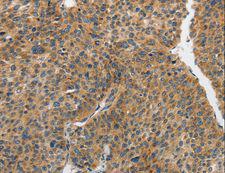 PIP5K1C Antibody - Immunohistochemistry of paraffin-embedded Human liver cancer using PIP5K1C Polyclonal Antibody at dilution of 1:25.