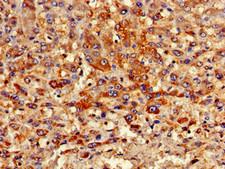 PIPOX / Sarcosine Oxidase Antibody - Immunohistochemistry of paraffin-embedded human liver cancer using PIPOX Antibody at dilution of 1:100