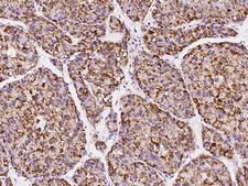 PIPOX / Sarcosine Oxidase Antibody - Immunochemical staining of human PIPOX in human hepatoma with rabbit polyclonal antibody at 1:1000 dilution, formalin-fixed paraffin embedded sections.