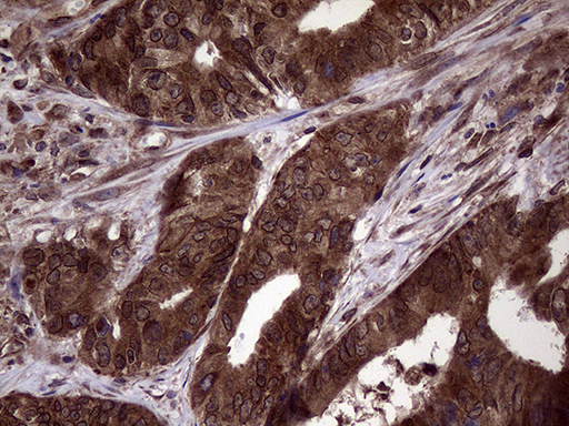 PITPNB Antibody - Immunohistochemical staining of paraffin-embedded Adenocarcinoma of Human colon tissue using anti-PITPNB mouse monoclonal antibody. (Heat-induced epitope retrieval by 1mM EDTA in 10mM Tris buffer. (pH8.5) at 120°C for 3 min. (1:2000)