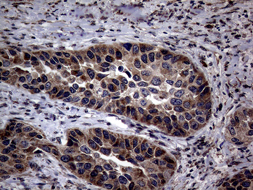 PITPNB Antibody - Immunohistochemical staining of paraffin-embedded Carcinoma of Human kidney tissue using anti-PITPNB mouse monoclonal antibody. (Heat-induced epitope retrieval by 1mM EDTA in 10mM Tris buffer. (pH8.5) at 120°C for 3 min. (1:2000)