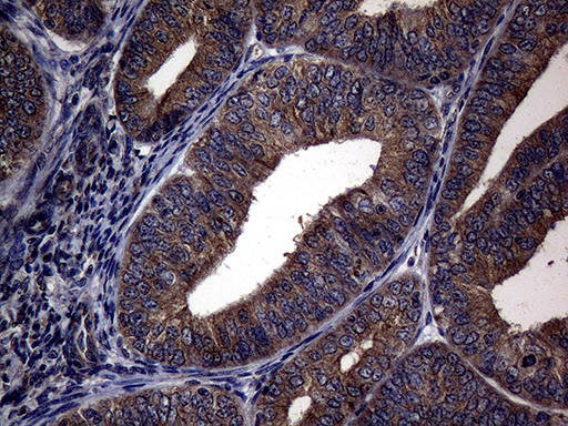 PITPNB Antibody - Immunohistochemical staining of paraffin-embedded Adenocarcinoma of Human endometrium tissue using anti-PITPNB mouse monoclonal antibody. (Heat-induced epitope retrieval by 1mM EDTA in 10mM Tris buffer. (pH8.5) at 120°C for 3 min. (1:2000)