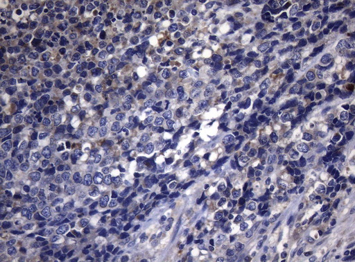 PITPNB Antibody - Immunohistochemical staining of paraffin-embedded Carcinoma of Human bladder tissue using anti-PITPNB mouse monoclonal antibody. (Heat-induced epitope retrieval by 1mM EDTA in 10mM Tris buffer. (pH8.5) at 120°C for 3 min. (1:150)