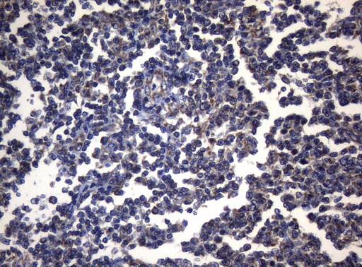 PITPNB Antibody - Immunohistochemical staining of paraffin-embedded Human lymphoma tissue using anti-PITPNB mouse monoclonal antibody. (Heat-induced epitope retrieval by 1mM EDTA in 10mM Tris buffer. (pH8.5) at 120°C for 3 min. (1:150)