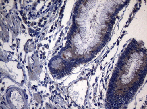 PITPNB Antibody - Immunohistochemical staining of paraffin-embedded Adenocarcinoma of Human colon tissue using anti-PITPNB mouse monoclonal antibody. (Heat-induced epitope retrieval by 1mM EDTA in 10mM Tris buffer. (pH8.5) at 120°C for 3 min. (1:150)