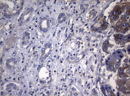 PITPNB Antibody - Immunohistochemical staining of paraffin-embedded Carcinoma of Human liver tissue using anti-PITPNB mouse monoclonal antibody. (Heat-induced epitope retrieval by 1mM EDTA in 10mM Tris buffer. (pH8.5) at 120°C for 3 min. (1:150)