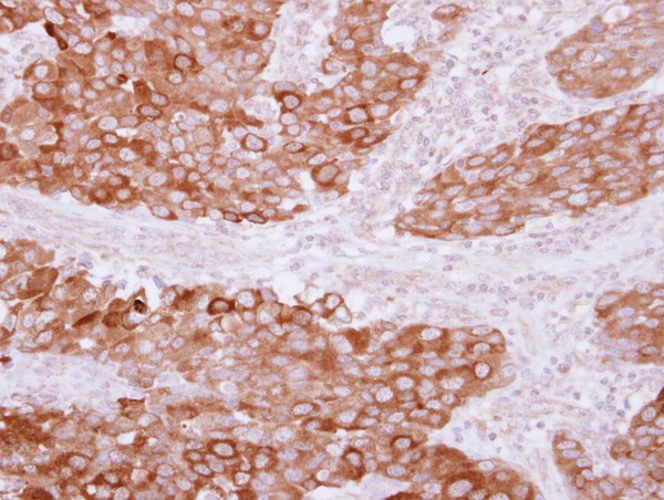 PITPNB Antibody - IHC of paraffin-embedded Breast ca, using PITPNB antibody at 1:500 dilution.