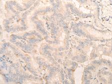 PITPNB Antibody - Immunohistochemistry of paraffin-embedded Human thyroid cancer tissue  using PITPNB Polyclonal Antibody at dilution of 1:25(×200)