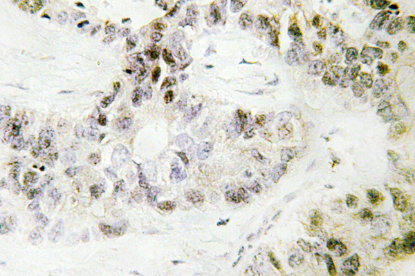 PITX1 Antibody - IHC of Pitx1 (E130) pAb in paraffin-embedded human lung carcinoma tissue.
