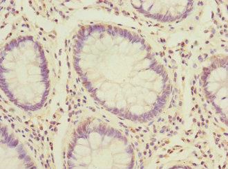 PK2 / PROK2 Antibody - Immunohistochemistry of paraffin-embedded human colon cancer at dilution 1:100