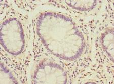 PK2 / PROK2 Antibody - Immunohistochemistry of paraffin-embedded human colon cancer at dilution 1:100