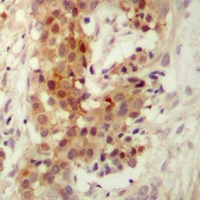 PKC Iota + PKC Zeta Antibody - Immunohistochemical analysis of PKC iota/zeta staining in human breast cancer formalin fixed paraffin embedded tissue section. The section was pre-treated using heat mediated antigen retrieval with sodium citrate buffer (pH 6.0). The section was then incubated with the antibody at room temperature and detected using an HRP polymer system. DAB was used as the chromogen. The section was then counterstained with hematoxylin and mounted with DPX.