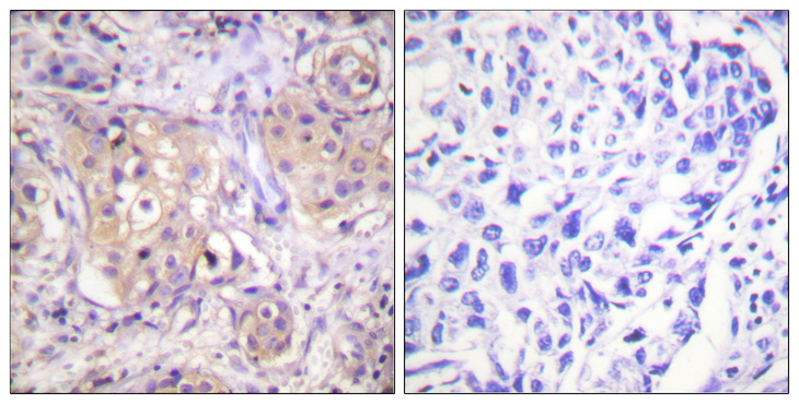 PKC / Protein Kinase C Antibody - Immunohistochemistry analysis of paraffin-embedded human breast carcinoma, using PKC-pan (Phospho-Thr497) Antibody. The picture on the right is blocked with the phospho peptide.
