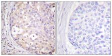 PKC / Protein Kinase C Antibody - Peptide - + Immunohistochemistry analysis of paraffin-embedded human breast carcinoma tissue using PKC-pan (Ab-497) antibody.