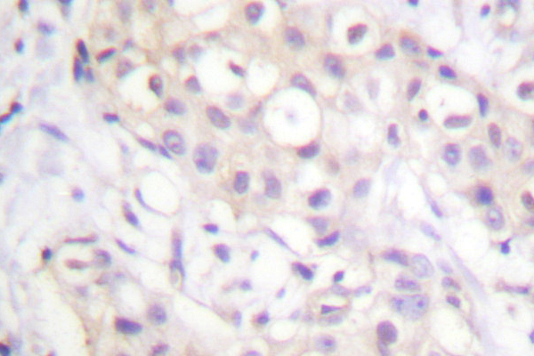 PKC / Protein Kinase C Antibody - IHC of PKC-pan (T495) pAb in paraffin-embedded human breast carcinoma tissue.