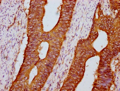 PKD1 / Polycystin Antibody - Immunohistochemistry Dilution at 1:600 and staining in paraffin-embedded human colon cancer performed on a Leica BondTM system. After dewaxing and hydration, antigen retrieval was mediated by high pressure in a citrate buffer (pH 6.0). Section was blocked with 10% normal Goat serum 30min at RT. Then primary antibody (1% BSA) was incubated at 4°C overnight. The primary is detected by a biotinylated Secondary antibody and visualized using an HRP conjugated SP system.