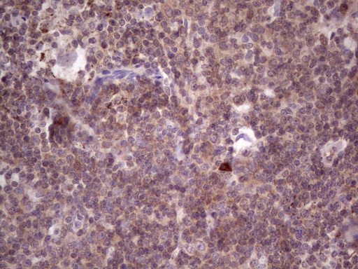 PKD3 / PRKD3 Antibody - Immunohistochemical staining of paraffin-embedded Carcinoma of Human lung tissue using anti-PRKD3 mouse monoclonal antibody. (Heat-induced epitope retrieval by 1 mM EDTA in 10mM Tris, pH8.5, 120C for 3min,