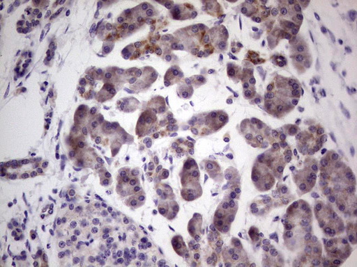 PKD3 / PRKD3 Antibody - Immunohistochemical staining of paraffin-embedded Carcinoma of Human pancreas tissue using anti-PRKD3 mouse monoclonal antibody. (Heat-induced epitope retrieval by 1 mM EDTA in 10mM Tris, pH8.5, 120C for 3min,