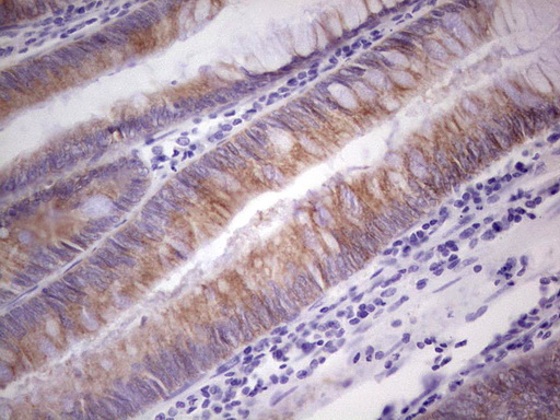 PKD3 / PRKD3 Antibody - Immunohistochemical staining of paraffin-embedded Adenocarcinoma of Human colon tissue using anti-PRKD3 mouse monoclonal antibody.  heat-induced epitope retrieval by 1 mM EDTA in 10mM Tris, pH8.5, 120C for 3min)