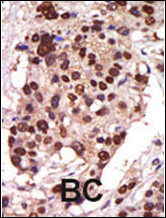 PKD3 / PRKD3 Antibody - Formalin-fixed and paraffin-embedded human cancer tissue reacted with the primary antibody, which was peroxidase-conjugated to the secondary antibody, followed by AEC staining. This data demonstrates the use of this antibody for immunohistochemistry; clinical relevance has not been evaluated. BC = breast carcinoma; HC = hepatocarcinoma.