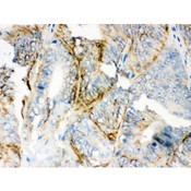 PKLR Antibody - PKLR antibody IHC-paraffin. IHC(P): Human Intestinal Cancer Tissue.