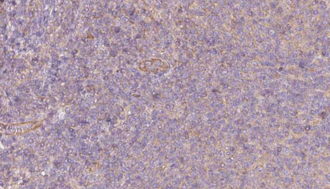 PKLR Antibody - 1:100 staining human lymph carcinoma tissue by IHC-P. The sample was formaldehyde fixed and a heat mediated antigen retrieval step in citrate buffer was performed. The sample was then blocked and incubated with the antibody for 1.5 hours at 22°C. An HRP conjugated goat anti-rabbit antibody was used as the secondary.