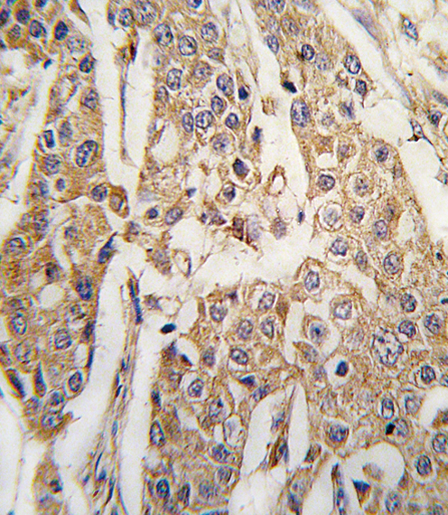 PKM / Pyruvate Kinase, Muscle Antibody - Formalin-fixed and paraffin-embedded human breast carcinoma tissue reacted with PKM2 antibody (C-term C474) , which was peroxidase-conjugated to the secondary antibody, followed by DAB staining. This data demonstrates the use of this antibody for immunohistochemistry; clinical relevance has not been evaluated.