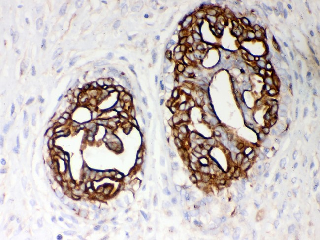 PKM / Pyruvate Kinase, Muscle Antibody - PKM2 antibody IHC-paraffin: Human Mammary Cancer Tissue.
