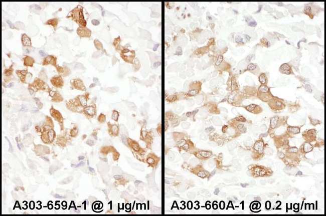 PKM / Pyruvate Kinase, Muscle Antibody - Detection of Human PKM2 by Immunohistochemistry. Samples: FFPE sections of human osteosarcoma. Antibody: Affinity purified rabbit anti-PKM2 used at a dilution of 1:5000. Detection: DAB.