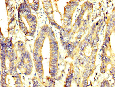 PKM / Pyruvate Kinase, Muscle Antibody - IHC image of PKM Antibody diluted at 1:400 and staining in paraffin-embedded human colon cancer performed on a Leica BondTM system. After dewaxing and hydration, antigen retrieval was mediated by high pressure in a citrate buffer (pH 6.0). Section was blocked with 10% normal goat serum 30min at RT. Then primary antibody (1% BSA) was incubated at 4°C overnight. The primary is detected by a biotinylated secondary antibody and visualized using an HRP conjugated SP system.