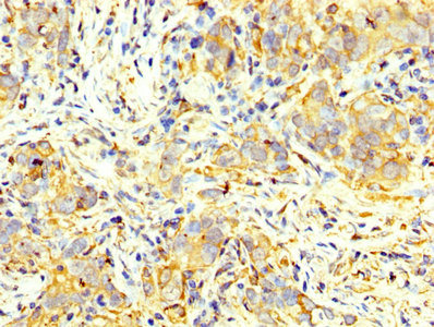 PKM / Pyruvate Kinase, Muscle Antibody - IHC image of PKM Antibody diluted at 1:400 and staining in paraffin-embedded human pancreatic cancer performed on a Leica BondTM system. After dewaxing and hydration, antigen retrieval was mediated by high pressure in a citrate buffer (pH 6.0). Section was blocked with 10% normal goat serum 30min at RT. Then primary antibody (1% BSA) was incubated at 4°C overnight. The primary is detected by a biotinylated secondary antibody and visualized using an HRP conjugated SP system.
