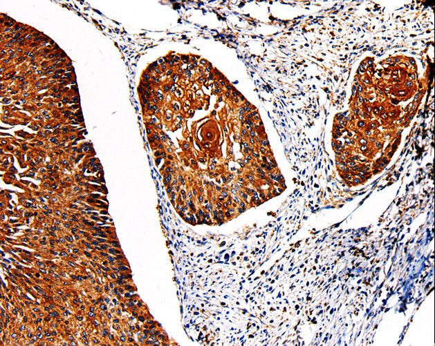 PKM / Pyruvate Kinase, Muscle Antibody - Immunohistochemistry of paraffin-embedded Human cervical cancer using PKM2 Polyclonal Antibody at dilution of 1:50.