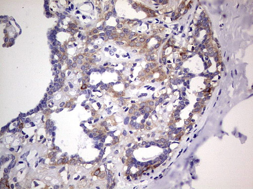PKM2 Antibody - IHC of paraffin-embedded Adenocarcinoma of Human breast tissue using anti-PKM2 mouse monoclonal antibody.