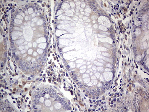 PKM2 Antibody - IHC of paraffin-embedded Human colon tissue using anti-PKM2 mouse monoclonal antibody.