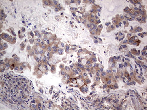 PKM2 Antibody - IHC of paraffin-embedded Carcinoma of Human lung tissue using anti-PKM2 mouse monoclonal antibody.
