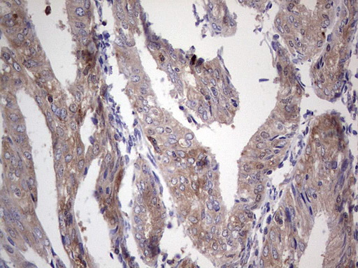 PKM2 Antibody - IHC of paraffin-embedded Adenocarcinoma of Human endometrium tissue using anti-PKM2 mouse monoclonal antibody.