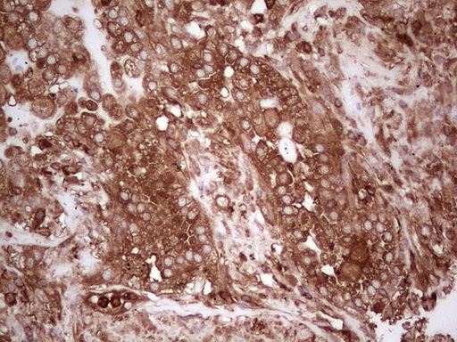 PKM2 Antibody - IHC of paraffin-embedded Carcinoma of Human lung tissue using anti-PKM2 mouse monoclonal antibody. (Heat-induced epitope retrieval by Tris-EDTA, pH8.0).