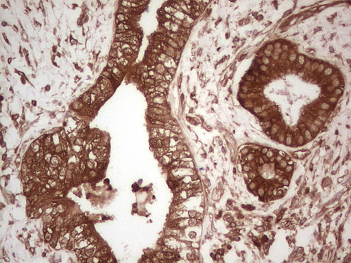 PKM2 Antibody - IHC of paraffin-embedded Carcinoma of Human pancreas tissue using anti-PKM2 mouse monoclonal antibody. (Heat-induced epitope retrieval by Tris-EDTA, pH8.0).