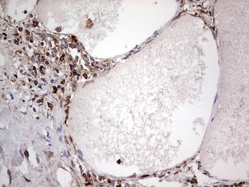 PKM2 Antibody - IHC of paraffin-embedded Human thyroid tissue using anti-PKM2 mouse monoclonal antibody.