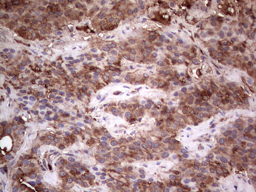 PKM2 Antibody - IHC of paraffin-embedded Carcinoma of Human thyroid tissue using anti-PKM2 mouse monoclonal antibody.