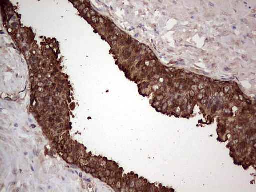 PKM2 Antibody - IHC of paraffin-embedded Carcinoma of Human prostate tissue using anti-PKM2 mouse monoclonal antibody.