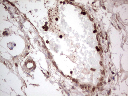 PKM2 Antibody - IHC of paraffin-embedded Carcinoma of Human bladder tissue using anti-PKM2 mouse monoclonal antibody.