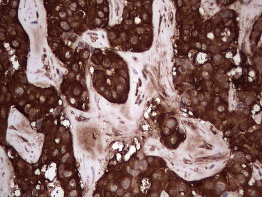 PKM2 Antibody - IHC of paraffin-embedded Carcinoma of Human liver tissue using anti-PKM2 mouse monoclonal antibody.