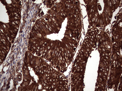 PKM2 Antibody - IHC of paraffin-embedded Adenocarcinoma of Human endometrium tissue using anti-PKM2 mouse monoclonal antibody.