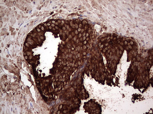 PKM2 Antibody - IHC of paraffin-embedded Carcinoma of Human prostate tissue using anti-PKM2 mouse monoclonal antibody.
