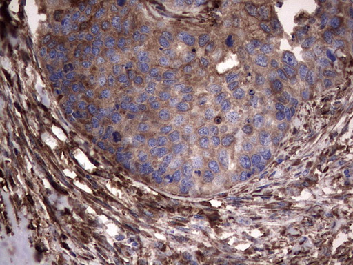 PKM2 Antibody - IHC of paraffin-embedded Carcinoma of Human kidney tissue using anti-PKM2 Mouse monoclonal antibody.