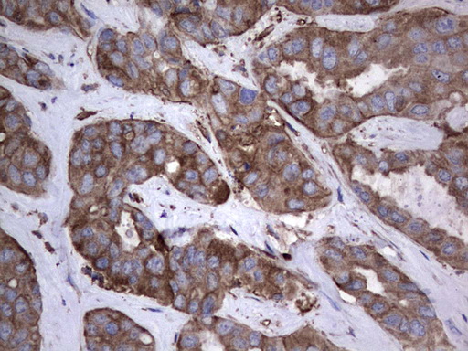 PKM2 Antibody - IHC of paraffin-embedded Carcinoma of Human liver tissue using anti-PKM2 Mouse monoclonal antibody.